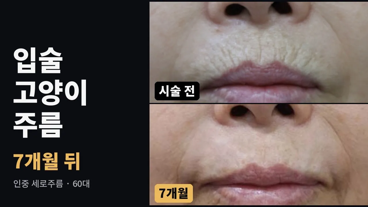 인중 세로주름 시술 전 → 2주 → 2개월 → 7개월 | 60대 중반 기계적 박피술 증례