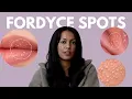 What are Fordyce Spots How Do You Get Rid of Them