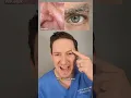 A dermatologist explains Seborrheic Dermatitis What is it How to treat