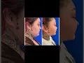 Jaidyn Alexxis gets Chin Lipo