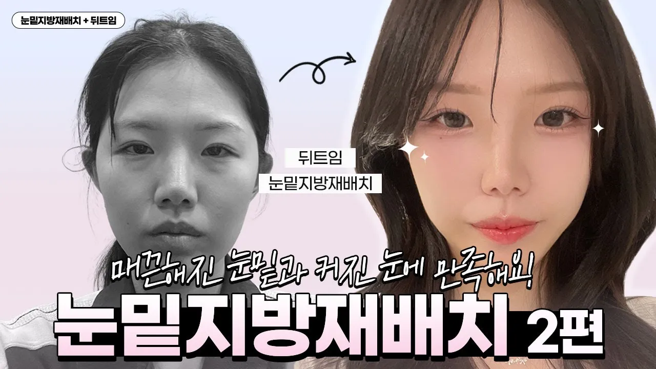 [VLOG] 👁‍🗨매끈해진 눈 밑과 자연스럽게 커진 눈에 너무 만족해요! 💖 눈밑지방재배치 + 뒤트임 2편