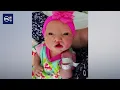 Living with cleft lip and palate