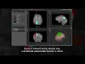 Research at NVIDIA 3D MRI Brain Tumor Segmentation Using Autoencoder Regularization