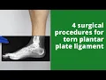 4 surgical procedures for torn plantar plate ligament