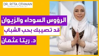 إزالة الرؤوس السوداء والزيوان  بسرعة لانها قد تسبب حب الشباب   د  ريتا عثمان دندنها