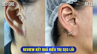 Sẹo lồi phẫu thuật thẩm mỹ - Cải thiện 60% sau 2 buổi điều trị tại phòng khám HHV Clinic.