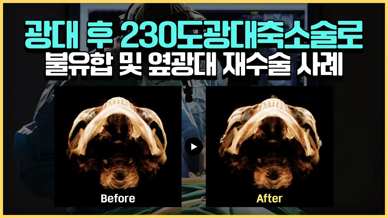 불유합 및 옆광대재수술 간단하게 해결방법은 없을까?