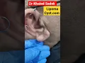 Download Lagu ear cyst! #shorts #cystremoval #skincare #pimplepopper Dr khaled sadek Lipomacyst.com