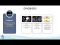 Right Ventricular Dysfunction in ARDS