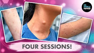 One Patient. 4 Steatocystoma Sessions. | Dr. Pimple Popper
