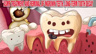 ASMR Treatment and Removal of Ingrown Teeth, Long-Term Tooth Decay | Deep Dental Cleaning