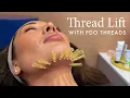 My PDO Thread Lift with Vanessa Lee at The Things We Do