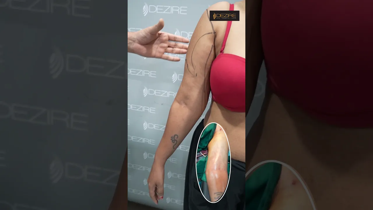 Arm Liposuction Result