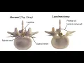 Foraminotomy CPT code - simplify medical coding