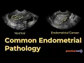 Don t Miss These Causes of Endometrial Thickness