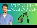 Gallbladder Bile Duct Disease explained by a GI doc
