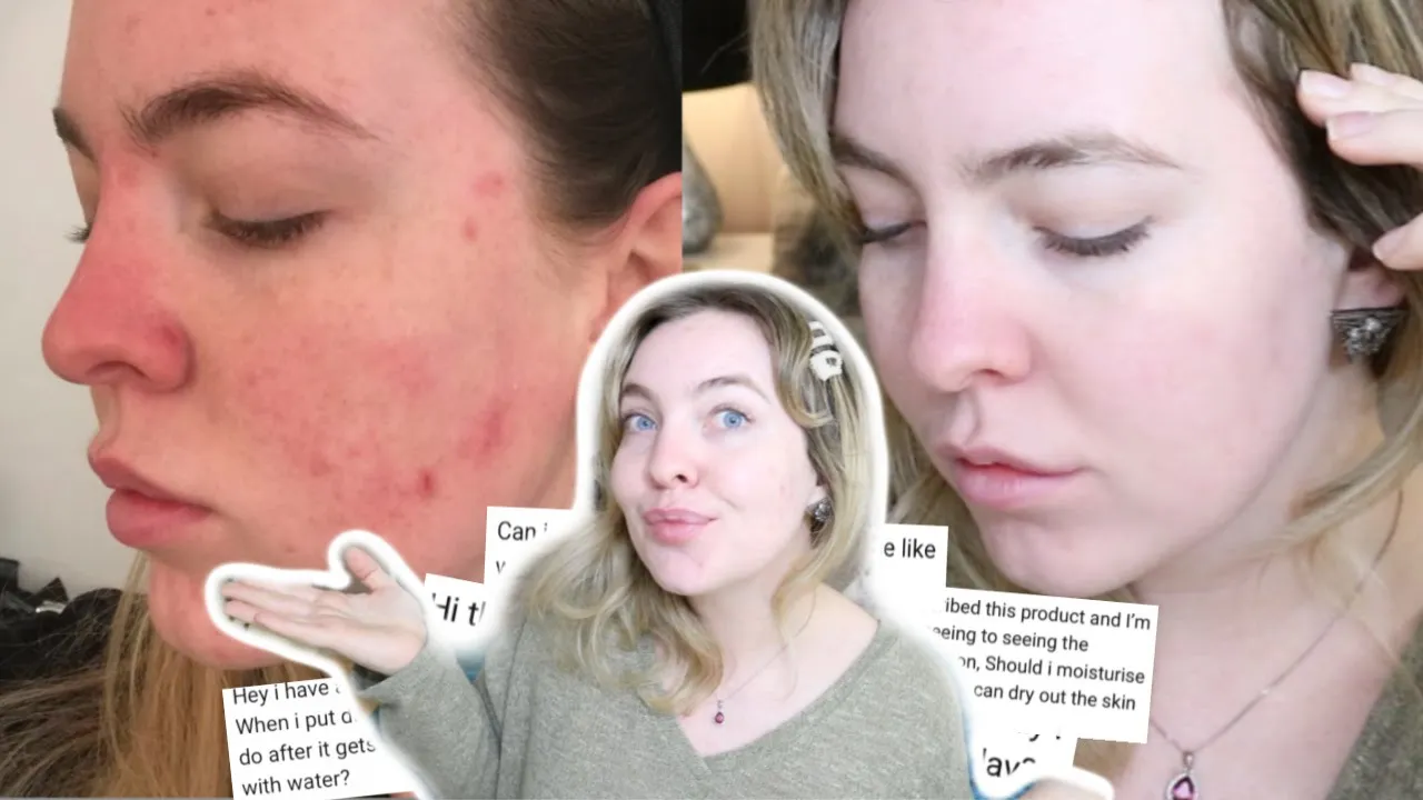 
          
          
          
            
            MY ACNE JOURNEY 1 YEAR LATER, HOW DUAC SAVED MY SKIN | ANSWERING YOUR QUESTIONS
          
        . 
