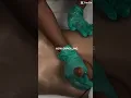 Post Op Manual Lymphatic Drainage Class 18 NCBTMB Credits Enroll