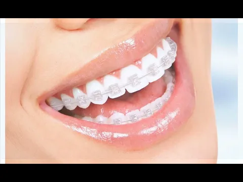 Video thumbnail: Smart Braces (CompleClear)
