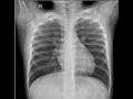 Python Simple Computer Vision Guided Project TensorFlow Pneumonia Prediction