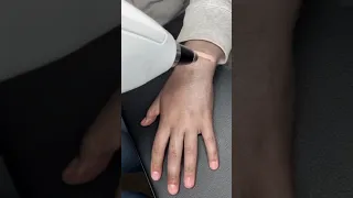 تغير لون الجلد بالليزر   دندنها
