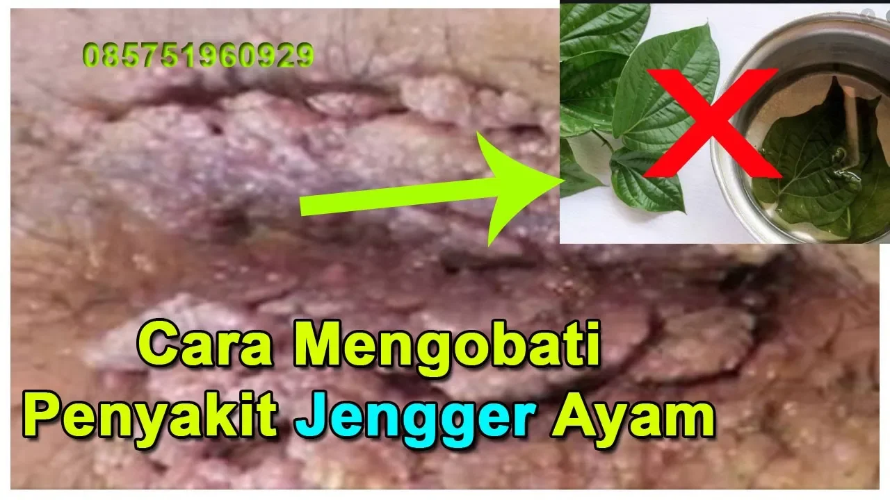 Cara Mengobati Penyakit Kutil Atau Cacar Pada Ayam | Penyebab Dan Akibatnya