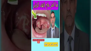 علاج التهاب اللوزتين Shorts محمد الفايد 