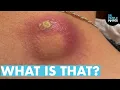 WHAT IS THAT Dr Lee Pops Satisfying Back Cyst Dr Pimple Popper Reacts
