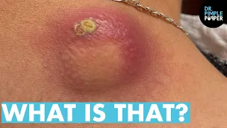 WHAT IS THAT Dr Lee Pops Satisfying Back Cyst Dr Pimple Popper Reacts