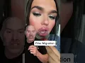 Lip Filler Started to Migrate Across Her Face