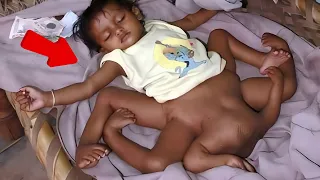 Born With 8 Limbs: Lakshmi Tatma's Incredible Story