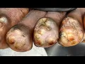 Amos Obukanga s final jiggers FREE - subscribe riseupsociety net 9 99 for such s