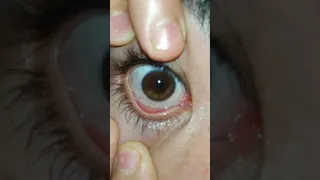 تجربتي مع السبليمنال لعيون الزرقاء شهر كامل شوفوا النتيجة 