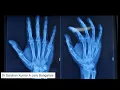 'K' wire fixation - Bouquet technique #handinjury