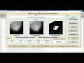Matlab Project BREAST CANCER DETECTION Using Image Processing BREAST CANCER DETECTION Using Matlab
