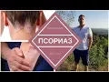 Download Lagu Псориаз. Истинные причины Псориаза и лечение