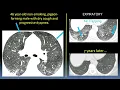 Download Lagu High-Resolution Chest CT - Course Sample