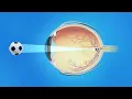 Nearsightedness Myopia