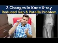 Knee x ray Knee Osteoarthritis Gap Reduced Chondromalacia patella Knee Joint Degeneration
