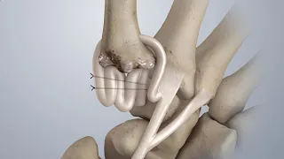 Osteoarthritis of the Thumb Surgical Treatment LRTI