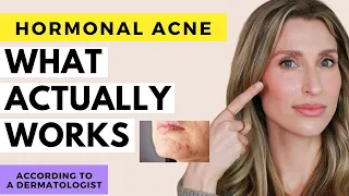 Fix Hormonal Acne For REAL Dr Sam Ellis