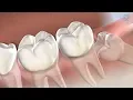 Wisdom Teeth Removal at Stephenville Oral Surgery Dental Implants Stephenville TX