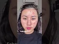 Lagu Beginilah kalau punya kulit Acne-Prone Skin🙈