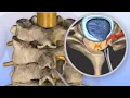 Hemilaminectomy CPT code - simplify medical coding