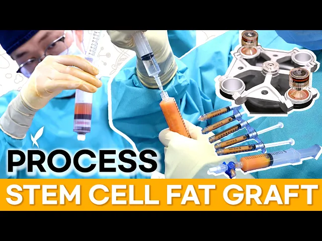 VIEW Plastic Surgery, STEM CELL FAT GRAFT