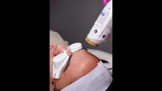What can laser do for your skin