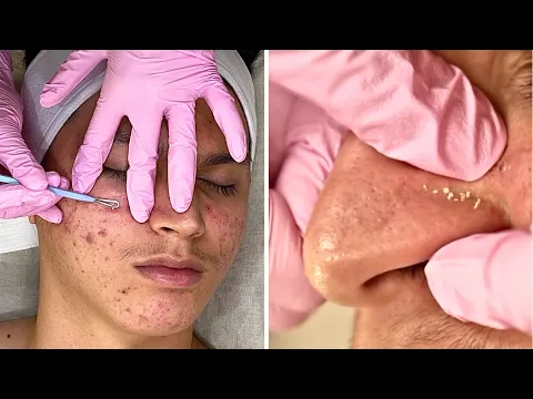Download MP3 Clearing Teen Cystic Acne Facial! Pimple Extractions & MORE! @Jadeywadey180