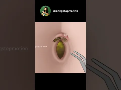 ASMR Oddly Satisfying Remove Huge Navel Stone | Navel cleaning | piercing removal #animation