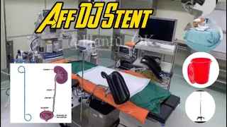 aff dj stent hantu ok djstent urologi urology sistoscopy