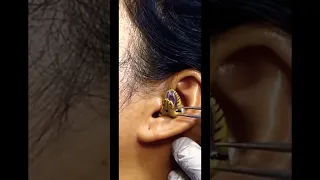 ثعبان في اذن امرأه من هنديه 